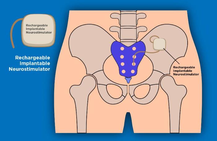 U.S. FDA Approves Aptar’s  Proprietary Activ-Film Technology for use with Rechargeable Implantable Neurostimulator